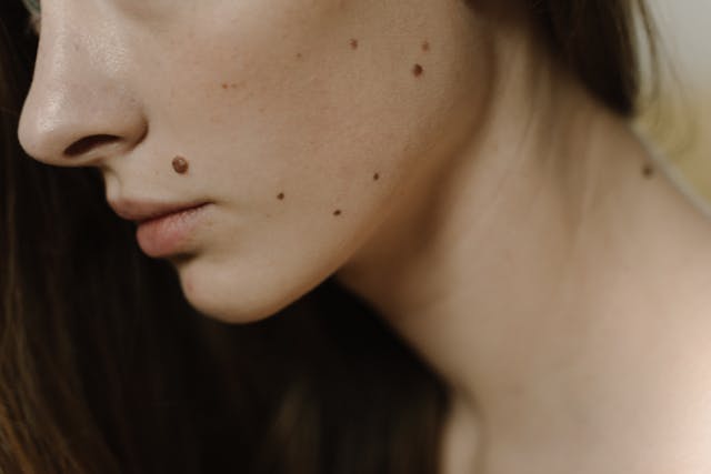 moles on face