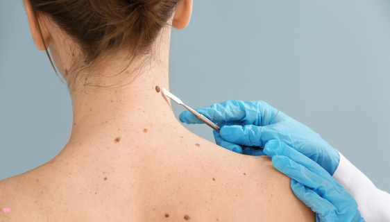 mole removal