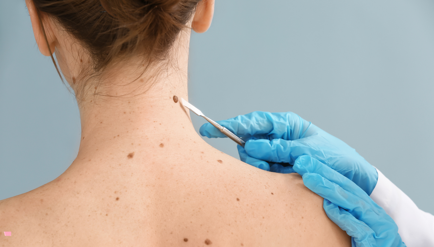 mole removal